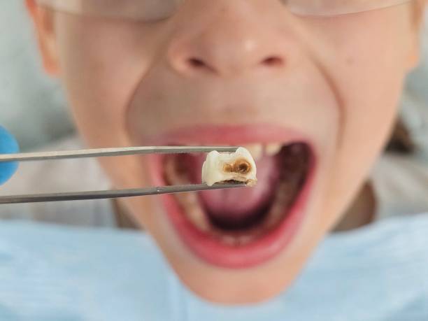Best Dentist for Tooth Abscess  in Hart, TX
